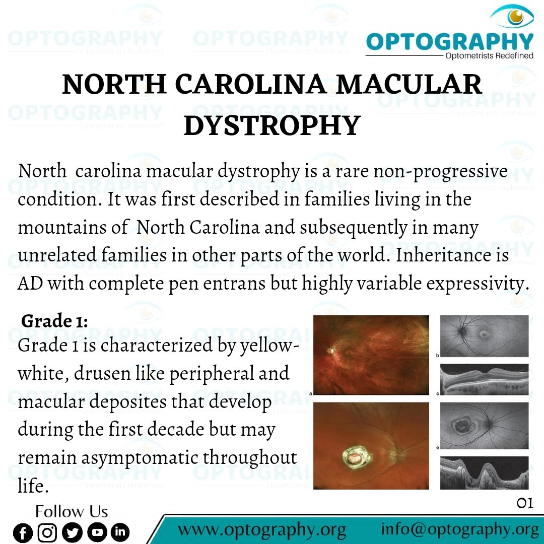 Optography8's tweet photo. North Carolina macular dystrophy (NCMD) is an inherited eye disorder that affects the development of the macula, the small, but important part of the eye located in the center of the retina.
#ncmd #eyecare #optography #optometrist #dilseoptometrist https://t.co/uS9pT2ewow