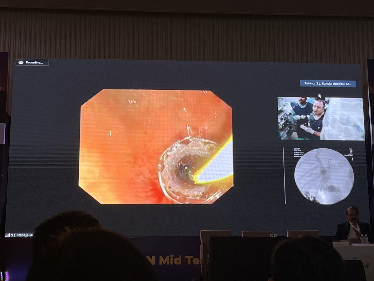 SahajRathi's tweet photo. @MouenKhashab masterfully demonstrating a multistep choledochoduodenostomy
π points
1οΈβ£Keep guidewire in EUS view at all times
2οΈβ£ Place a plastic stent to straighten out the axis
Lots of learning going on at the mid-term #ENDOCON, India #EUS summit 2022
#GITwitter https://t.co/7iWEIDVTxz