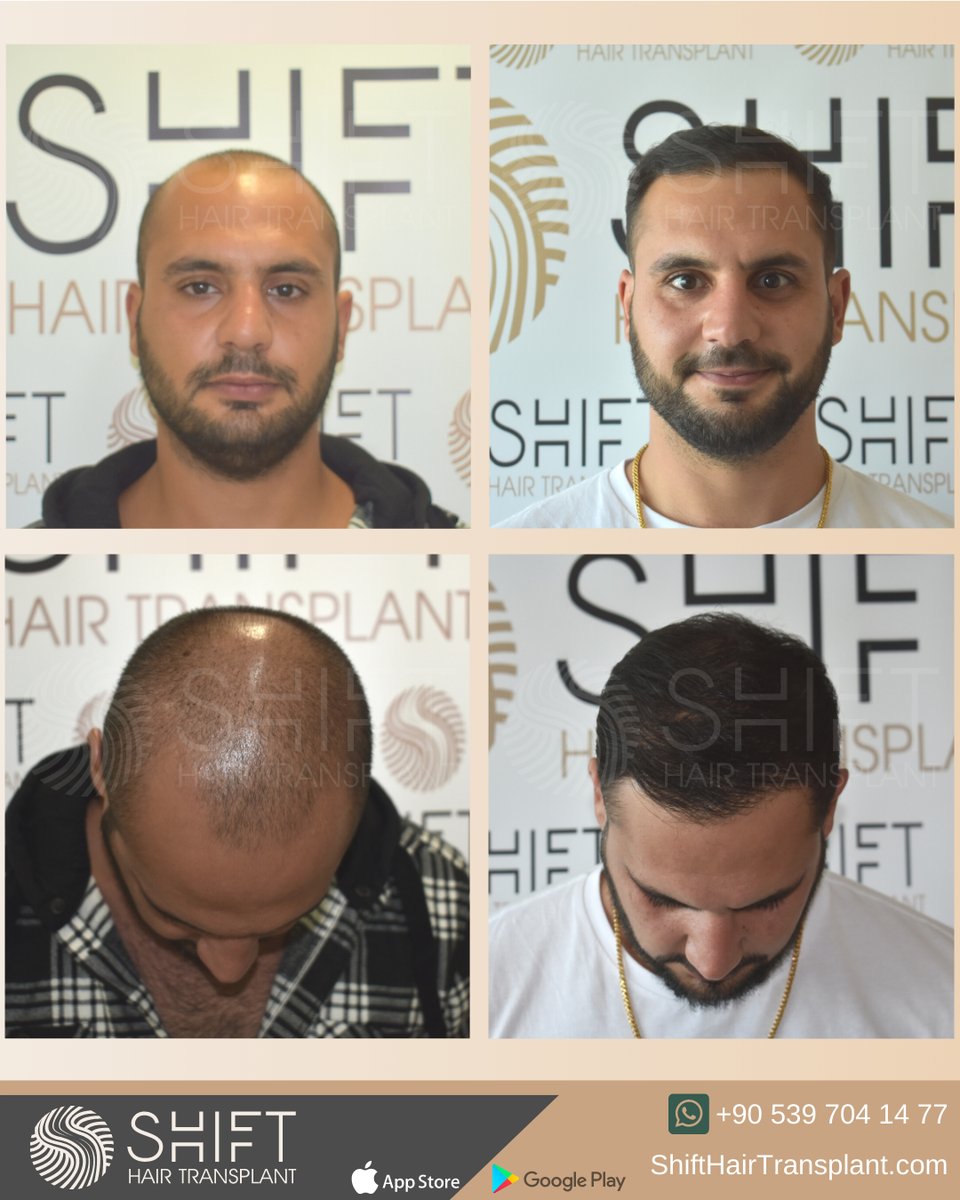 SHIFT Hair Transplant (@shifthairtrans) / Twitter SHIFT Hair Transplant (@shifthairtrans) / Twitter