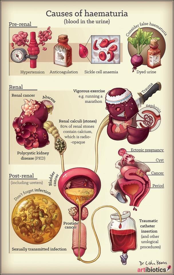 Causes of hematuria <a href="/artibiotics/">Ciléin Kearns</a> #Medtwitter