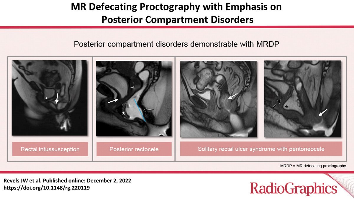 MR Defecating Proctography with Emphasis on Posterior Compartment Disorders pubs.rsna.org/doi/10.1148/rg…