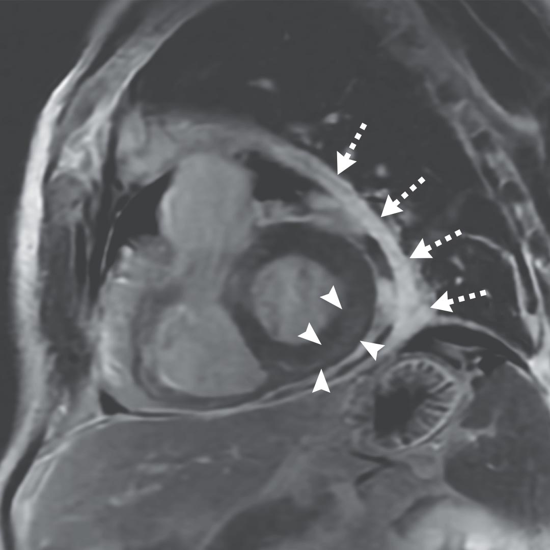NEJM On Twitter A 64 year old Man Presented To A Rheumatology Clinic nejm-on-twitter-a-64-year-old-man-presented-to-a-rheumatology-clinic