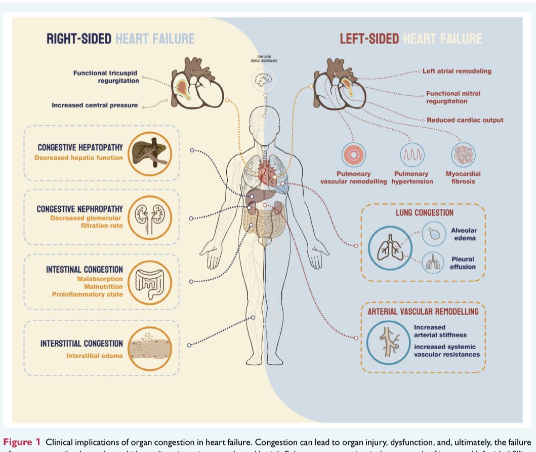 GiuseppeGalati_'s tweet photo. Great overview by #HFA_ESC on biomarkers of #congestion in #HeartFailure
🔥Right vs Left #HF
🔥Fluid redistribution vs Volume Overload
🔥 Acute vs Chronic Comgestion Phenotypes
🌟Intriguing role of #bioADM
@JJheart_doc @gcfmd @JBauersachsMD 
@JavedButler1

https://t.co/ozfzU0QoL6 https://t.co/xPpljTr04U