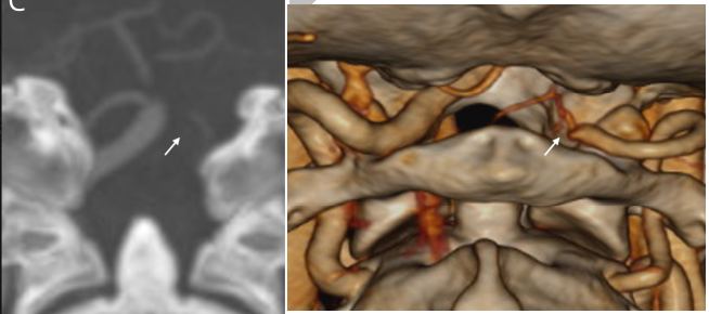 tychicuschen's tweet photo. @sudhakar_satti @GreenJournal @VancouverStroke @ubcneuro Indeed a left vert V4 occlusion - no comment on acute treatment or outcome, only secondary prevention https://t.co/T8cFcI85xM