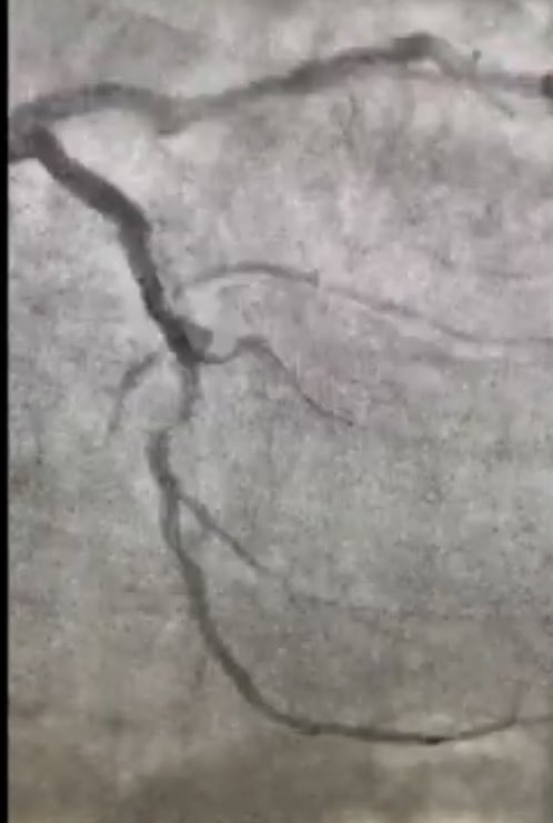 HadyLichaaMD's tweet photo. #DeflectableTip #MicroCatheter use in #ComplexCoronary #Bifurcation
https://t.co/wfXBnazpVD
@SCAI @kerrigjl @timir_paul @EAPCIPresident @PCRonline @kaschenke @mirvatalasnag @mmamas1973 @lindsey_cilia @agtruesdell @RhianEDavies1 @zghouzi @adityadoc1 @DrSethdb @Babar_Basir https://t.co/oLKHpc0ZFL