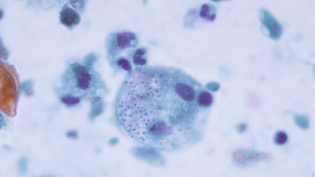 guzalagupadu's tweet photo. BAL, H. capsulatum, 🔬 #citopathology #pathology #fungus  #BAL #infectiousdiseases https://t.co/3lhigVwipL