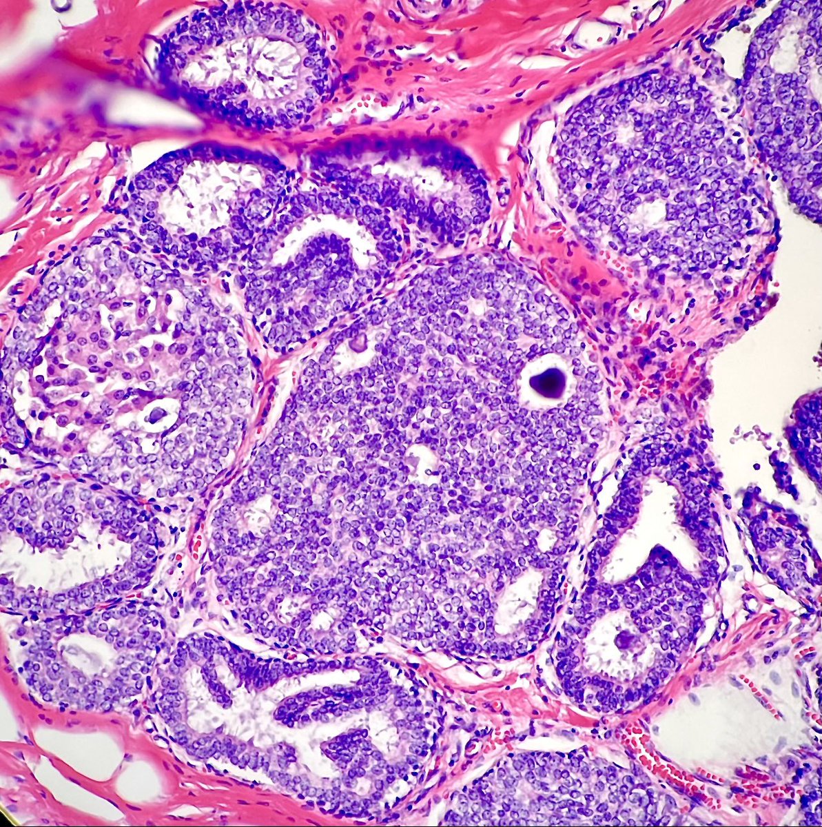 What do you see in this DCIS? #PathTwitter #MedTwitter #pathresidents #breastpath #breastbiopsy 🙄🙄