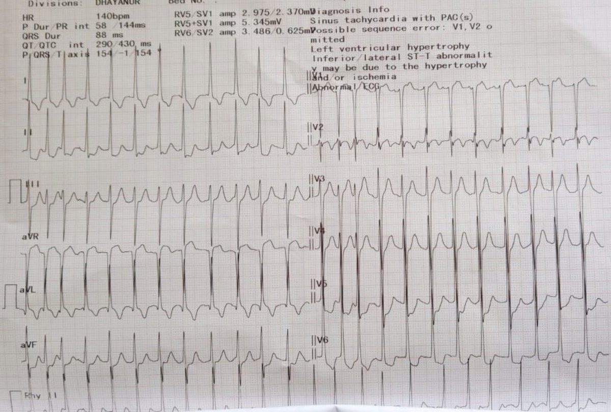 Spot the anomaly (Clue - aVL) between AI ECG (PMcardio and Conventional ECG) Can AI really beat us in ECG game ? @narrowQRS @PMcardioBot @JasonWinterECG @E
