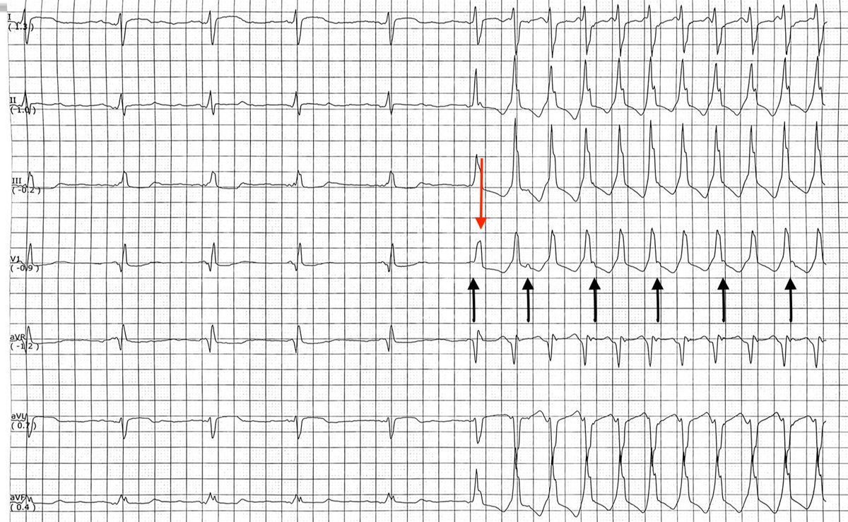 CardiacSchool's tweet photo. Answer: A - VT

Broad complex tachycardia. The first beat of the tachycardia is likely a fused beat (red arrow). During the tachycardia V>A is noted (P waves highlighted by black arrows), consistent with VT. Biopsy showed 2R rejection. https://t.co/I9tHFFmTws