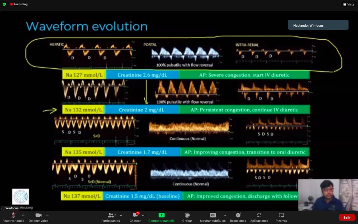 Tubulocentric's tweet photo. Probably one of the scenarios where volume assessment is critical is hyponatraemia. Wonderfully @NephroP explained how #PoCUS should be a fundamental part of clinical assessment. #WINFOCUS22 @SENefrologia @senjoven @PNephrology @ArgaizR @rdelaespriella @sengndi https://t.co/0RvbI3S8sN