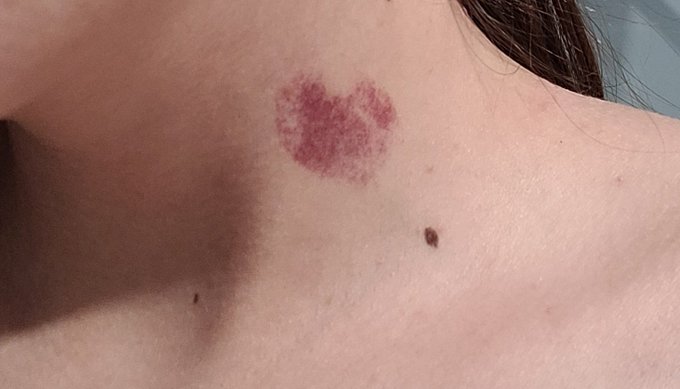 Heart-shaped hickey https://t.co/kRSGkEjNrj