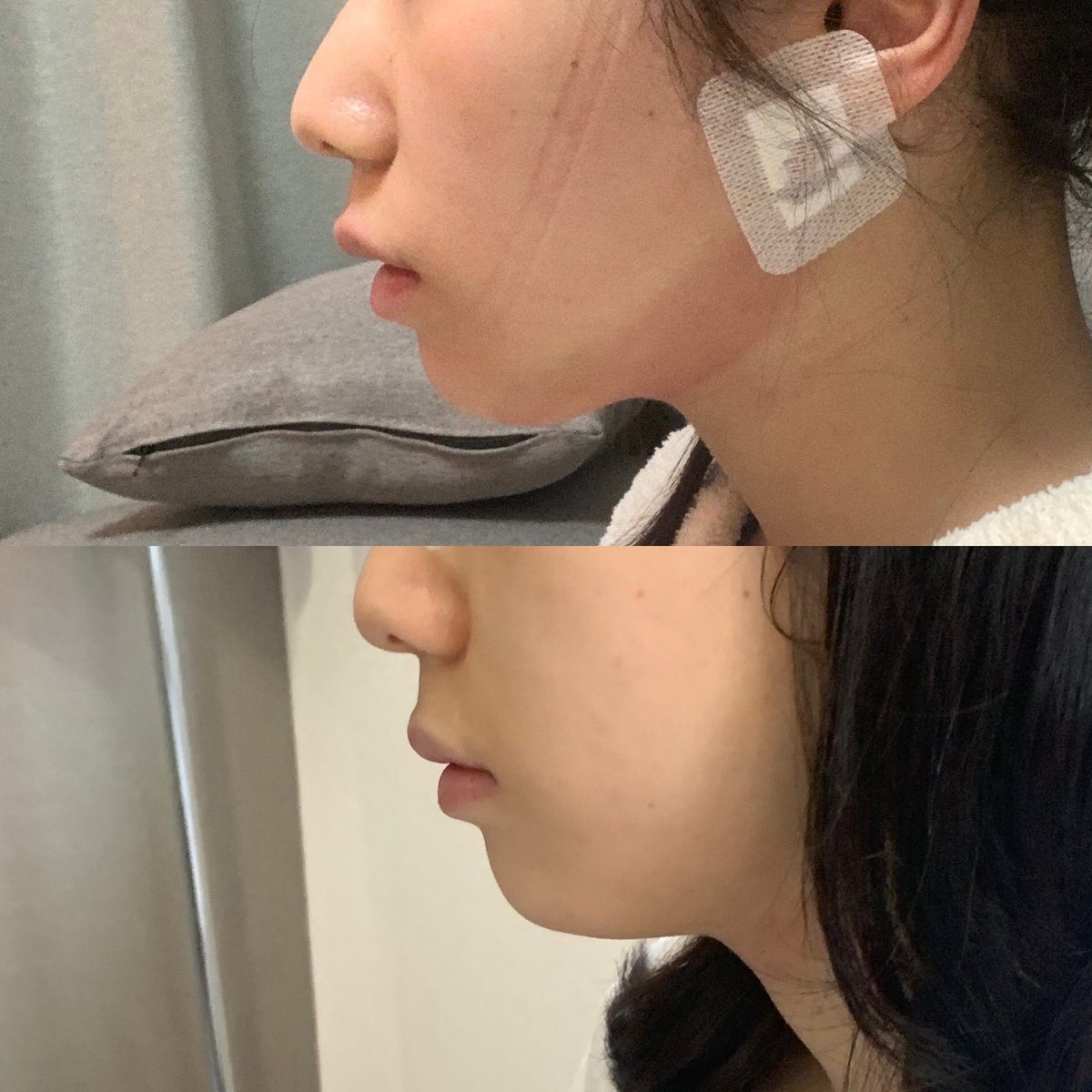 uyuiii20's tweet photo. Oggiclinicで顎下脂肪吸引してきました！
麻酔も施術も私は思ってたより痛くなくて良かった‥
そしてなにより格安。
麻酔で腫れていても顎下スッキリしてて顎できてて嬉しい😢顎下のみ純脂肪で30ccほど取っていただきました。 https://t.co/PdEcqI2sb5