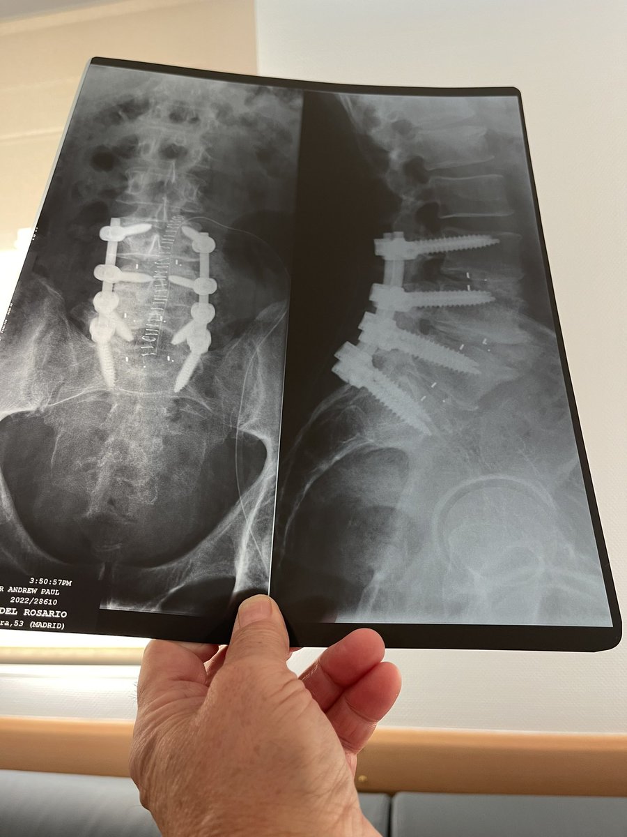 andrewrosemeyer's tweet photo. Ni los 8 tornillos en la columna me puede conmigo. #backsurgey #herniadiscal #spine #surgery https://t.co/90k8jPyxNP