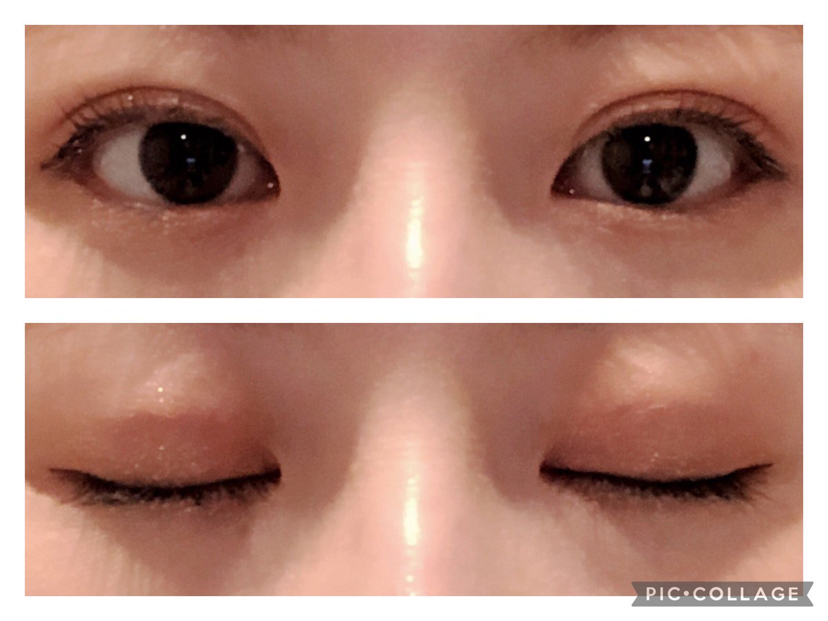 penpen___o's tweet photo. 埋没44日後 メイク有り
たまにはメイク有り写真です。埋没してから今までのメイクが合わなくなり研究して今に至る😌
まつ毛を上げすぎないほうが二重が綺麗に見えていいなと✨

今更ながら１ヶ月検診の予約しようと思ったら全然空いてなくて年明けになった😂
#二重埋没 #札幌 https://t.co/lPJNWgosp5