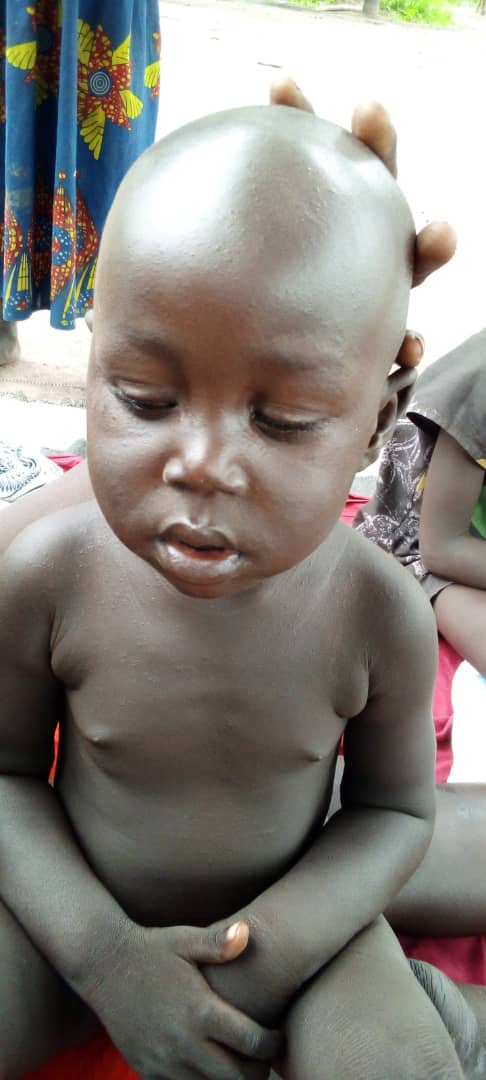 JuolHon's tweet photo. Measles outbreak is reported in Cueibet County  in Lakes State, South Sudan.  There are  confirmed deaths and 30 persons under quarantine. We are calling upon the government of South Sudan  to intervene as soon as possible before it escalates. https://t.co/nhJuws6F2L