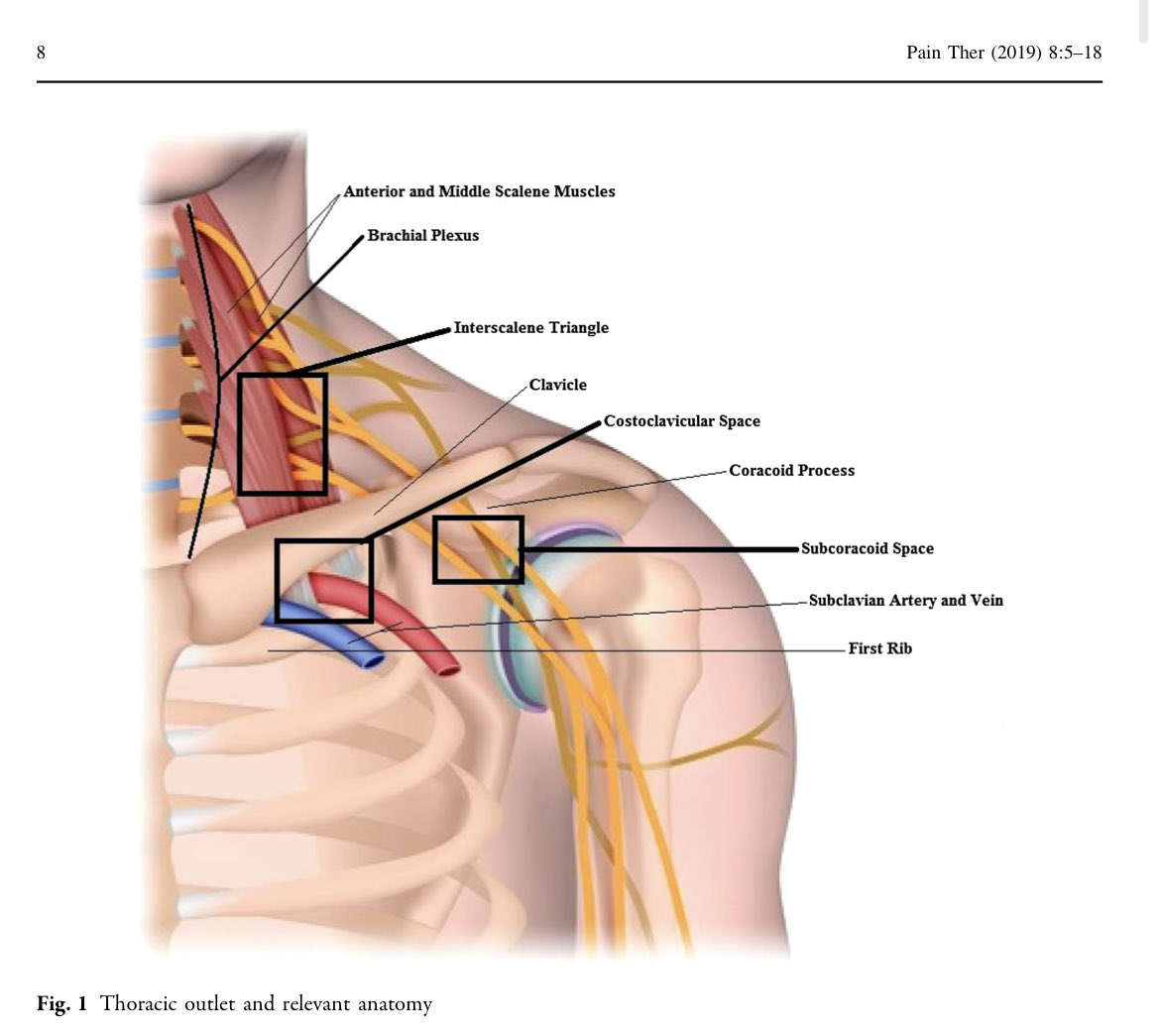 MaxVanDerVelden's tweet photo. Thoracic outlet syndrome is, for me, one of those conditions around the shoulder/neck that I’m not really confident in treating.

So I decided to have a closer look at the literature. Be aware, this is not a heavily researched area so much is based on low quality evidence.

🧵 https://t.co/iJW6pv6DOQ
