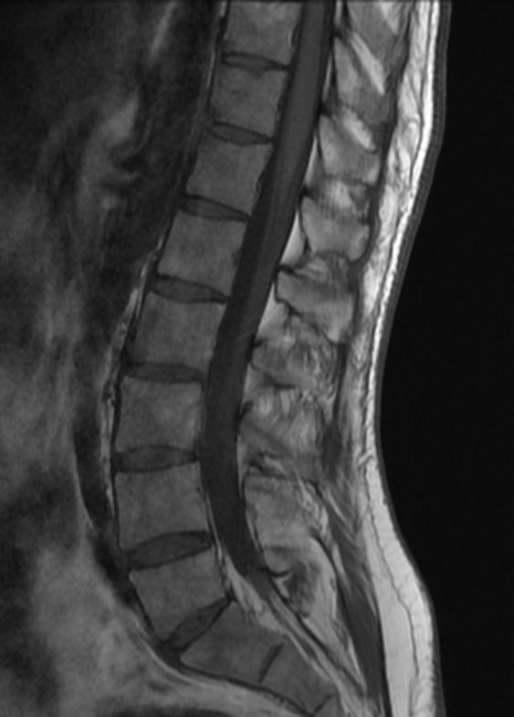 mskteachingroom's tweet image. Theme: Spine
Back pain in a 30-year-old👨
What are the salient imaging findings? Any further imaging suggested?  What further investigations might be useful 💉?
#mskrad #spinerad #radtwitter #radres