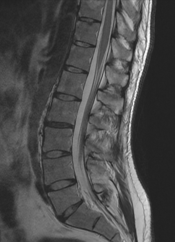 mskteachingroom's tweet image. Theme: Spine
Back pain in a 30-year-old👨
What are the salient imaging findings? Any further imaging suggested?  What further investigations might be useful 💉?
#mskrad #spinerad #radtwitter #radres