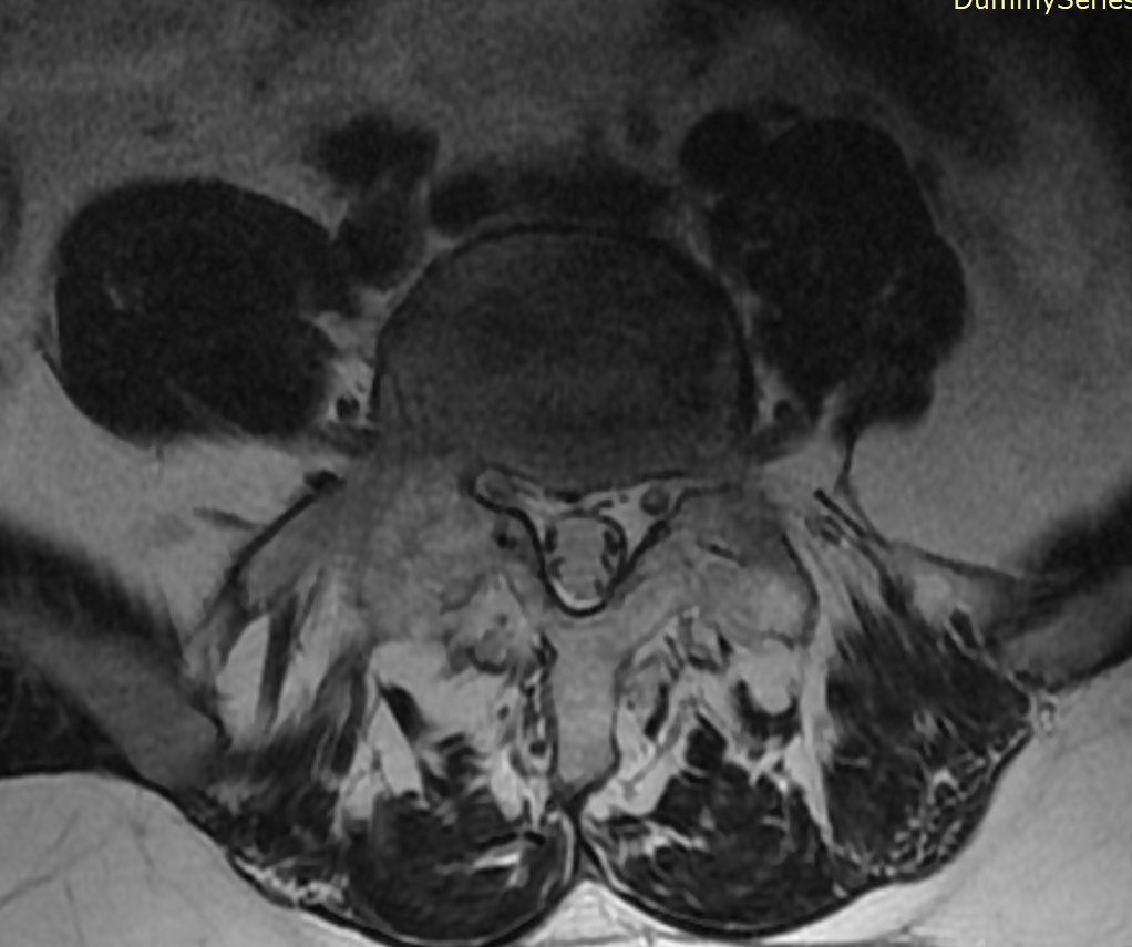 mskteachingroom's tweet image. Theme: Spine
Back pain in a 30-year-old👨
What are the salient imaging findings? Any further imaging suggested?  What further investigations might be useful 💉?
#mskrad #spinerad #radtwitter #radres