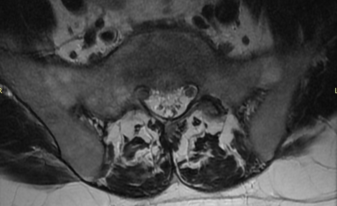 mskteachingroom's tweet image. Theme: Spine
Back pain in a 30-year-old👨
What are the salient imaging findings? Any further imaging suggested?  What further investigations might be useful 💉?
#mskrad #spinerad #radtwitter #radres