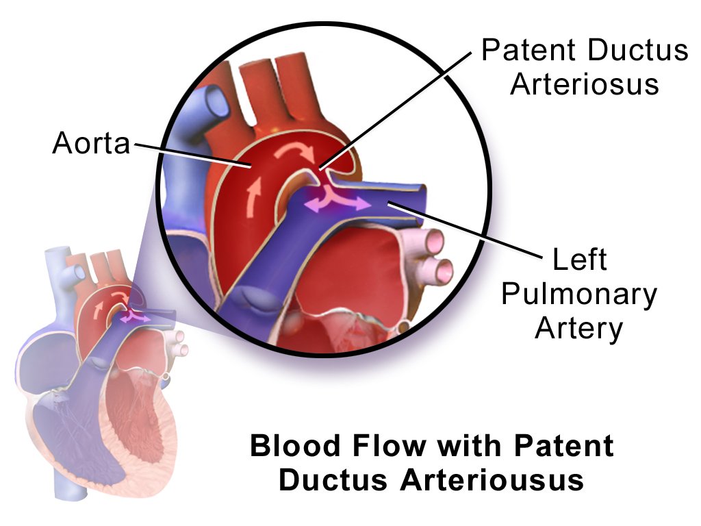 NICU_Musings's tweet photo. Much as we might wish it, no apparent advantage to acetaminophen &amp; ibuprofen in combination vs alone in closing a PDA in this systematic review
On the plus side I can guarantee no baby in the dual groups had headaches during treatment 😀
https://t.co/LBUBh264QZ
#neoTwitter https://t.co/BVCdg4V9dz