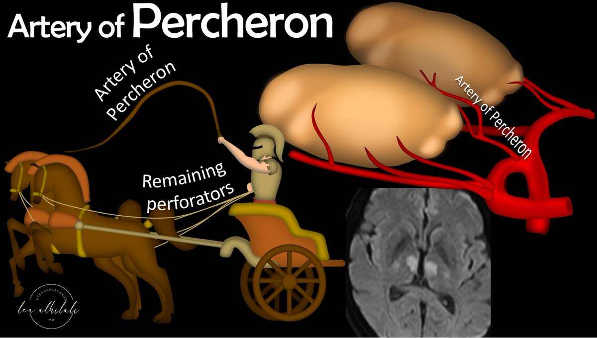 Classic boards case!

Artery of Percheron occlusion--anatomic variant(single paramedian artery to both thalami)
'Percheron' is a horse breed & anatomy looks like basilar driving thalamic horses! Other perforators are reins & percheron is the single whip to both horses
#medtwitter