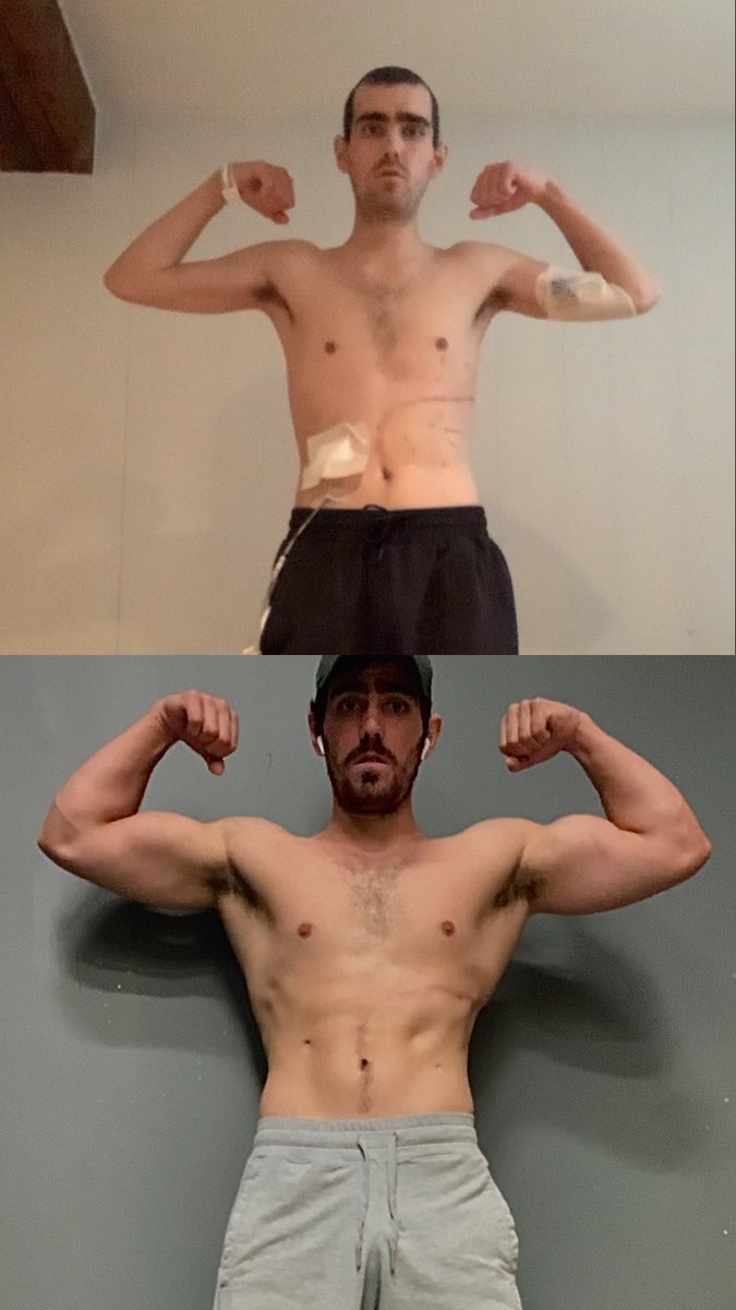 Connor72Smith's tweet image. A Year Ago Today I Was Diagnosed With Acute Myeloid Leukaemia

I spent 4 months in hospital.

I lost my lower lob of a lung, my spleen and some stomach battling an infection. 

This How I Built Myself Back From 0 From April to October 💪🏼