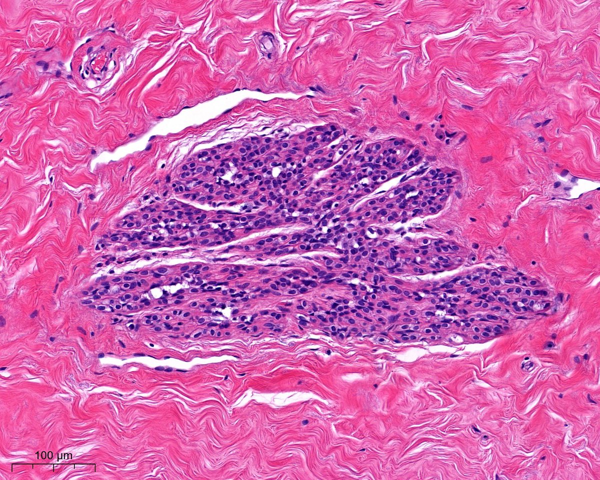 A. Polónia (@poloniaantonio) on Twitter photo Middle-age F, breast reduction. I know you see this...😃 #breastpath <a href="/atman_ci/">Dr. Luca</a> <a href="/ADamronMD/">Alexander Damron, MD</a> <a href="/LizaMQuintana/">Liza Quintana, MD</a> <a href="/AGrabenstetter/">Anne Grabenstetter</a> <a href="/DrGeeONE/">Olaleke Folaranmi</a> <a href="/tlabiano/">Tania Labiano</a> <a href="/AmPathology/">Ana Marques</a> <a href="/jennpincus/">Jenny Pincus, MD</a> <a href="/ariella8/">Celina Stayerman MD</a> <a href="/nusrat_xahra/">🔻Nusrat Zahra🔻🇵🇸</a> @miss_me1986 <a href="/gonzadetoro/">Gonzalo De Toro</a> <a href="/TristanRutland7/">Tristan Rutland MBBS FRCPA IFCAP</a> <a href="/LoboAnandi/">Anandi Lobo, MD</a> <a href="/SumantaDas_7/">Sumanta Das</a> <a href="/israhkhan/">Israh Akhtar Khan</a> Middle-age F, breast reduction. I know you see this...😃 #breastpath <a href="/atman_ci/">Dr. Luca</a> <a href="/ADamronMD/">Alexander Damron, MD</a> <a href="/LizaMQuintana/">Liza Quintana, MD</a> <a href="/AGrabenstetter/">Anne Grabenstetter</a> <a href="/DrGeeONE/">Olaleke Folaranmi</a> <a href="/tlabiano/">Tania Labiano</a> <a href="/AmPathology/">Ana Marques</a> <a href="/jennpincus/">Jenny Pincus, MD</a> <a href="/ariella8/">Celina Stayerman MD</a> <a href="/nusrat_xahra/">🔻Nusrat Zahra🔻🇵🇸</a> @miss_me1986 <a href="/gonzadetoro/">Gonzalo De Toro</a> <a href="/TristanRutland7/">Tristan Rutland MBBS FRCPA IFCAP</a> <a href="/LoboAnandi/">Anandi Lobo, MD</a> <a href="/SumantaDas_7/">Sumanta Das</a> <a href="/israhkhan/">Israh Akhtar Khan</a>