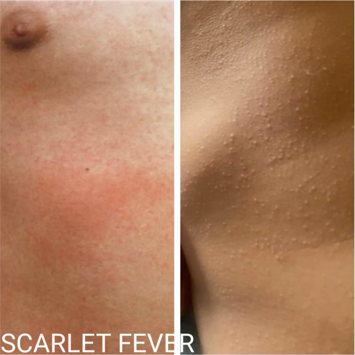 The scarlet fever rash is historically described as bright red, but on people of color this can clearly be inaccurate; the rash may simply be flesh colored along with the characteristic sandpapery feel and appearance. #Pediatrics #MedTwitter #ScarletFever