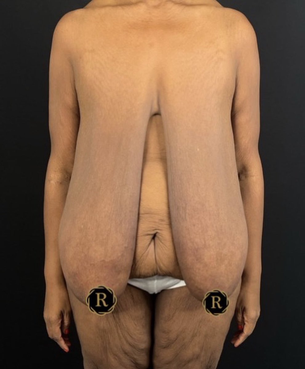 TheCosmeticLane's tweet image. This breast reduction transformation is beyond anything we have seen before.