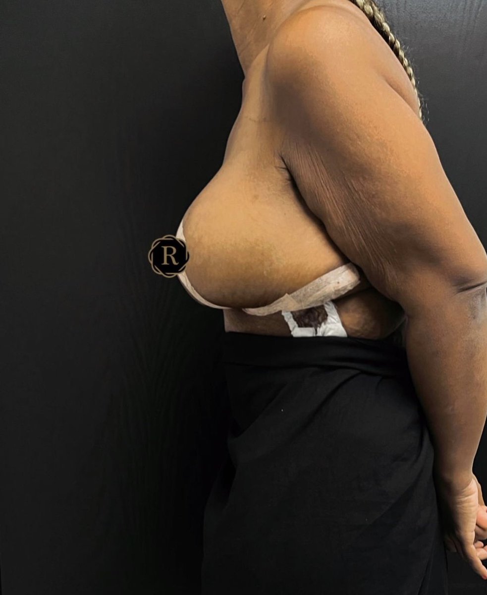 TheCosmeticLane's tweet image. This breast reduction transformation is beyond anything we have seen before.