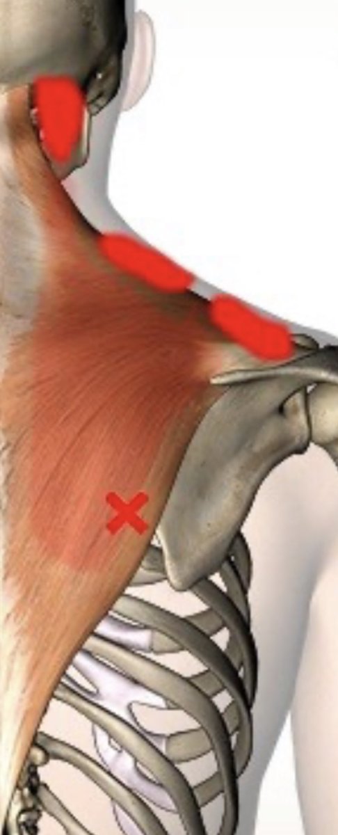 Johnny_196502's tweet image. Over die schouder en nek…
Precies de zgn. #TriggerPoints
Daar zit de pijn en het episch centrum zit bij het lage triggerpoint (het kruisje)