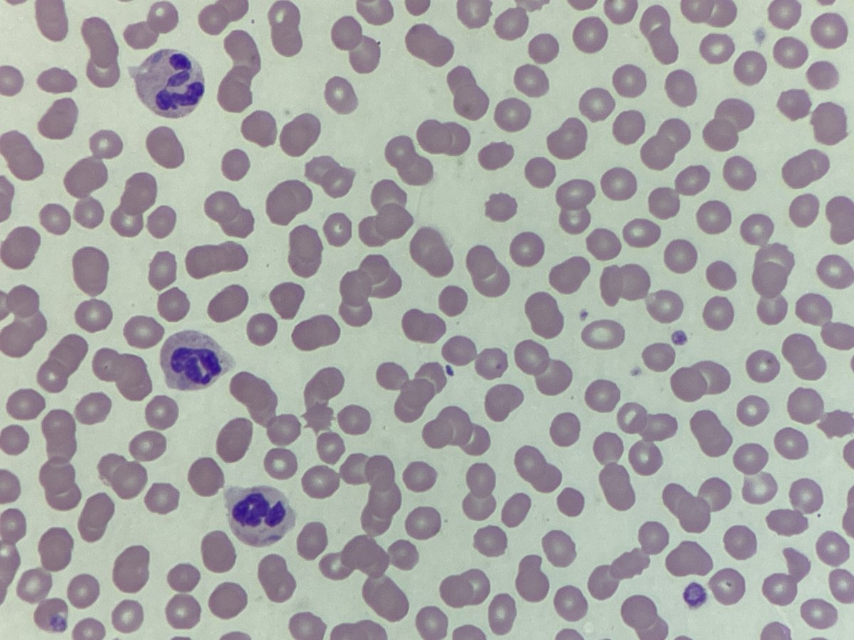 #MorphologyMonday

4 images, 1 diagnosis. For a bonus point, what's the mutation that causes it?

#OnlyCells #underthescope