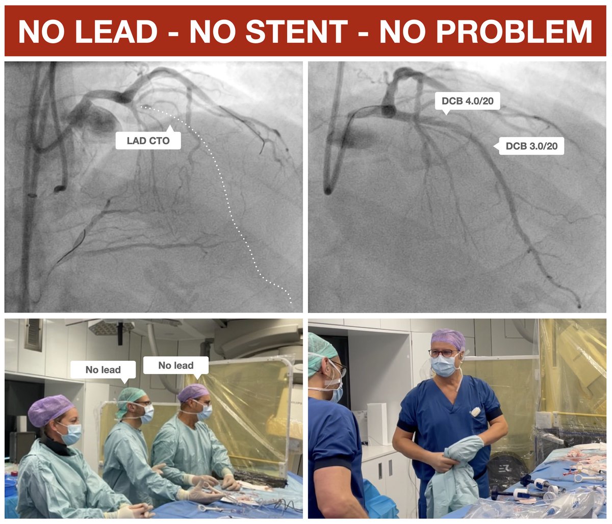 No lead, no stent, no worries…
Thanx to <a href="/ACTOS_VUmc/">ACTOS</a> we were able to perform a DCB only CTO-PCI of the LAD with Rampart. We truly believe this will be the future with excellent long-term outcome for both the patient and operators.