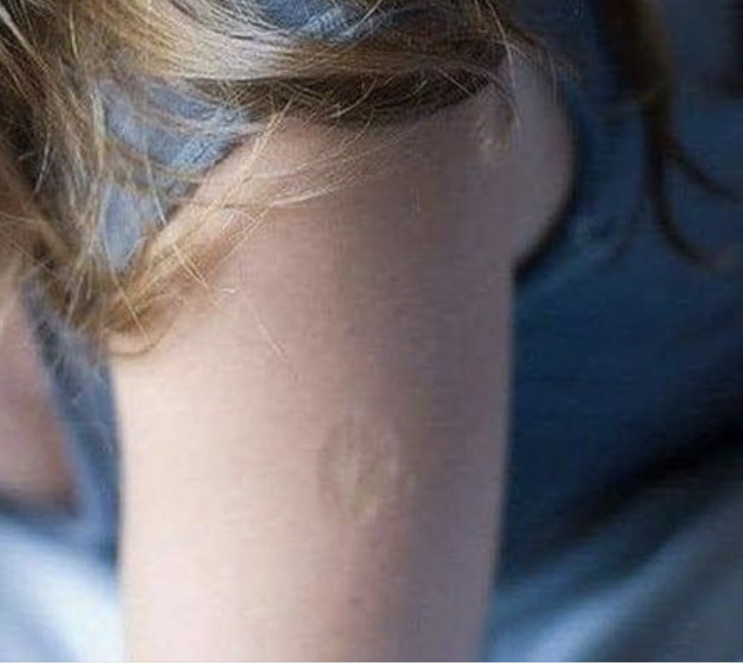 🖤K🖤 on Twitter "You have the scar from the smallpox vaccine? I do"