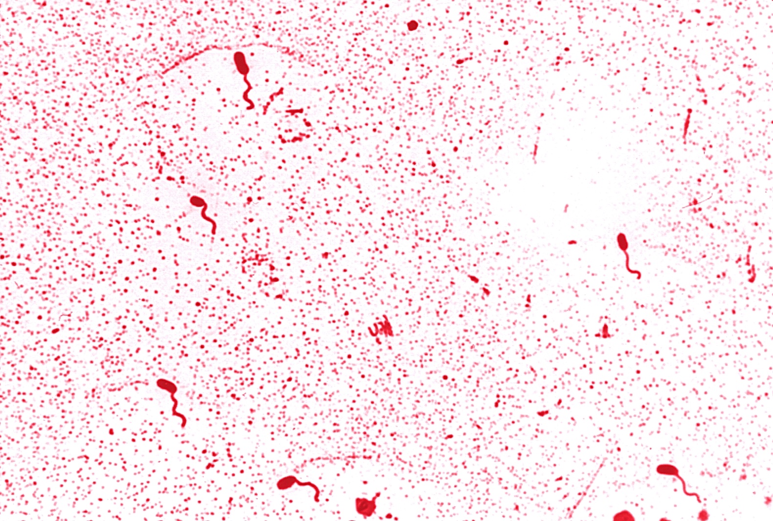 Brown Hospital Medicine on Twitter "A patient in Kenya presented with