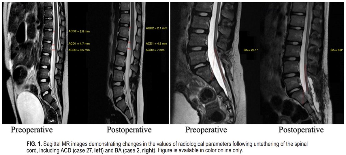William Mualem (@williammualem) on Twitter photo The decision to operate on a child with tethered cord syndrome can be complex.
We defined radiological parameters such as bending angle (BA) and showed that a BA of >=31.7 degrees may predict a higher risk of re-operation.
pubmed.ncbi.nlm.nih.gov/36461831/
<a href="/MohamadBydon/">Mohamad Bydon, M.D.</a> <a href="/MayoNeuroInfo/">Mayo Clinic Neuro-Informatics Lab</a> The decision to operate on a child with tethered cord syndrome can be complex.
We defined radiological parameters such as bending angle (BA) and showed that a BA of >=31.7 degrees may predict a higher risk of re-operation.
pubmed.ncbi.nlm.nih.gov/36461831/
<a href="/MohamadBydon/">Mohamad Bydon, M.D.</a> <a href="/MayoNeuroInfo/">Mayo Clinic Neuro-Informatics Lab</a>