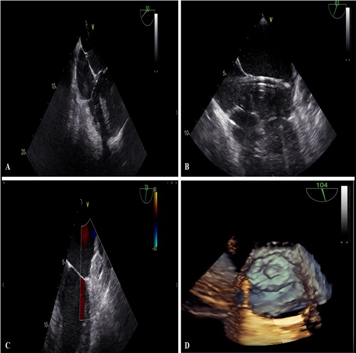 RCMjournal's tweet photo. #RCM-Special Issue: Structural Heart Interventions (3/6)
☀️Left Atrial Appendage Closure: A Current Overview Focused on Technical Aspects and Different Approaches
@FGuarracini @Daniele_Muser @gasperettimd
#LeftAtrialAppendageClosure #LAAC #AF
Full text:
https://t.co/0UJdT4hK8l https://t.co/DRBXQfF3V6