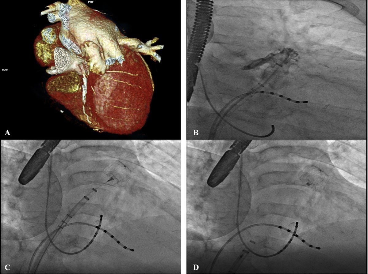RCMjournal's tweet photo. #RCM-Special Issue: Structural Heart Interventions (3/6)
☀️Left Atrial Appendage Closure: A Current Overview Focused on Technical Aspects and Different Approaches
@FGuarracini @Daniele_Muser @gasperettimd
#LeftAtrialAppendageClosure #LAAC #AF
Full text:
https://t.co/0UJdT4hK8l https://t.co/DRBXQfF3V6