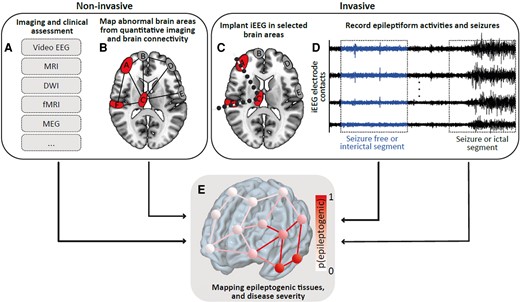 Localizing epileptogenic tissues in epilepsy: are we losing (the) focus?

New scientific commentary by Nishant Sinha bit.ly/3FqM0ud; bit.ly/3unuaBN