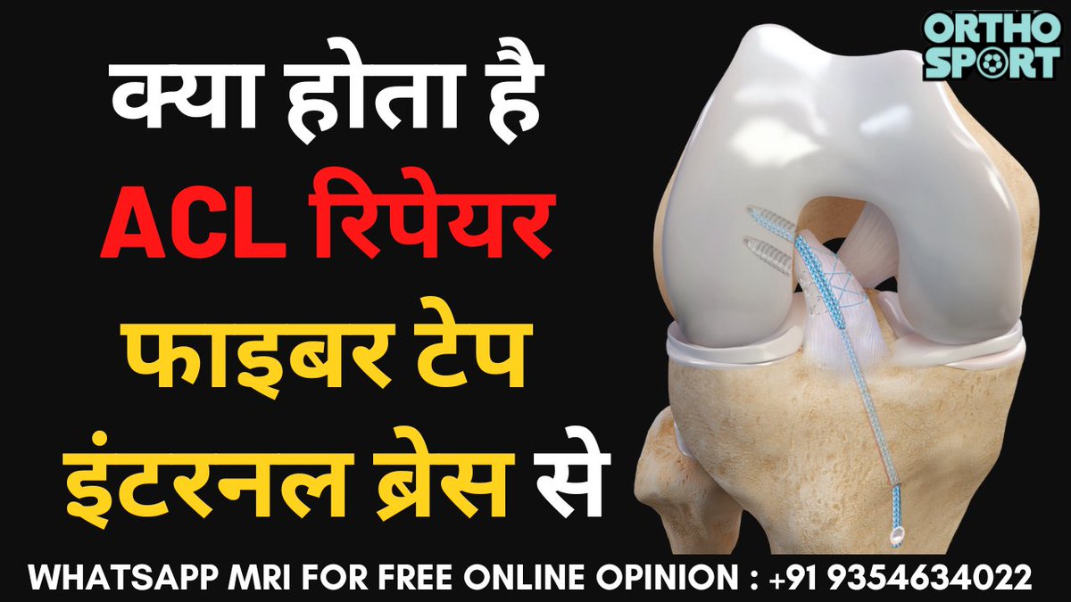 drmanubora's tweet photo. क्या होता है #ACL रिपेयर फाइबर टेप इंटरनल ब्रेस से | ACL #Repair with FiberTape Internal Brace
Checkout full video on YouTube- https://t.co/tq2BRqxqbz https://t.co/D4ZMjdpJhr