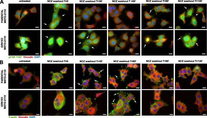 sbarro_health's tweet photo. #ResearchAlert: "Complexity of progranulin mechanisms of action in mesothelioma"
Link to the publication: https://t.co/fQLQdj3kqQ
#SHRO #MadeAtSHRO #DiscoveredAtSHRO #mesothelioma #progranulin #EphA2 #lungcancer https://t.co/fLDGUCN5yL