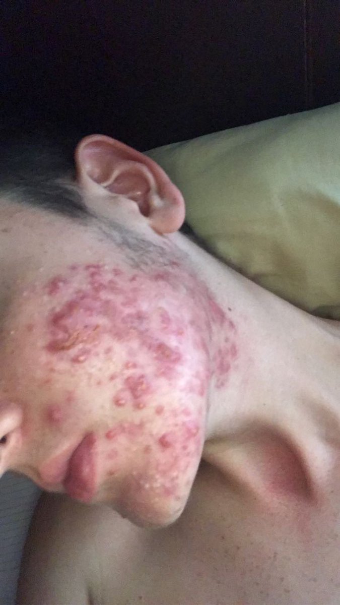 johan_rc07's tweet photo. Me siento estúpido al publicar esto
tan tarde,pero siempre ha dado
miedo mostrarle a la gente mi
apariencia.Ha pasado más de unos meses desde que empecé el roaccutane y ha sido 100% lo más difícil que tuve que hacer y arruinó mi autoestima y mi cuerpo físicamente durante meses. https://t.co/J6mHiGaQQx