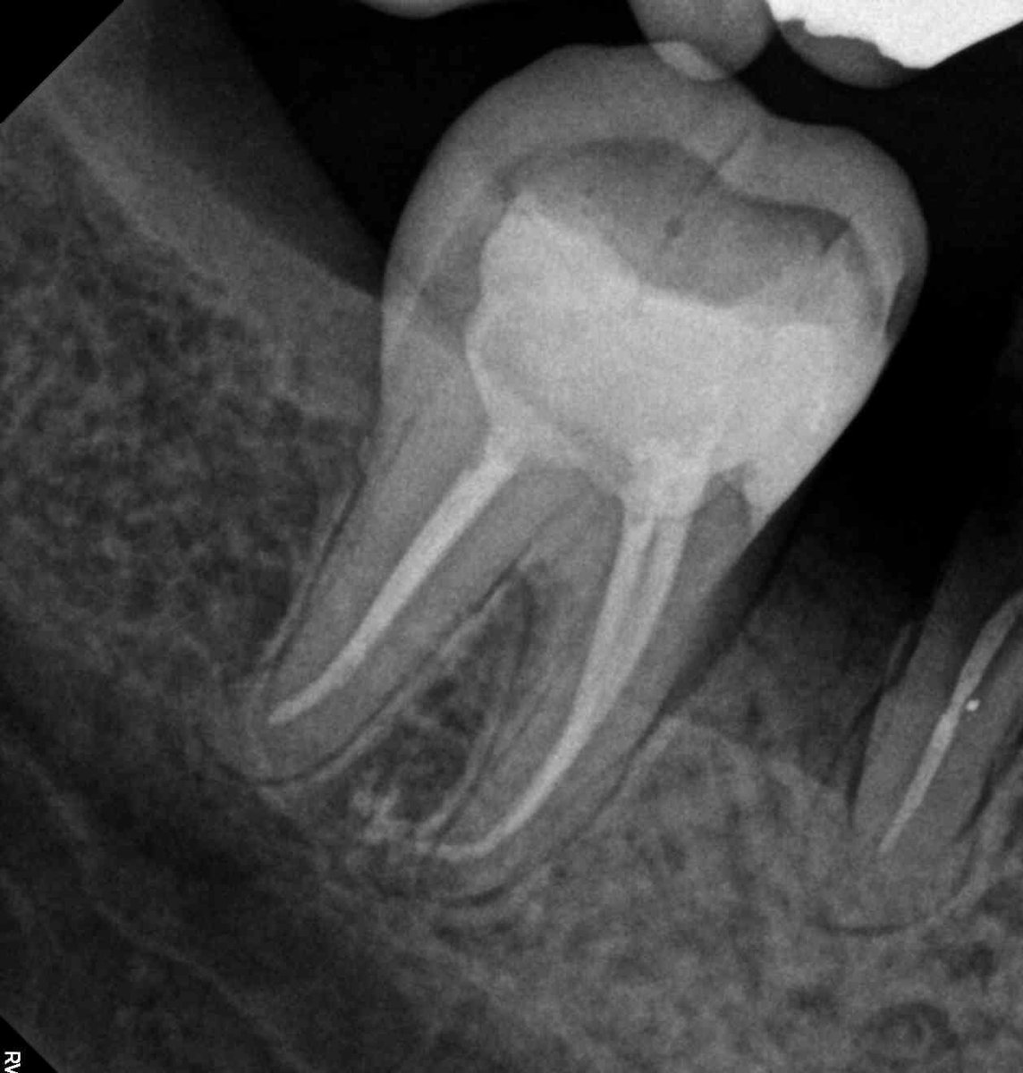 a_sa_dent's tweet photo. RCT of #47 
علاج عصب لضرس سفلي 

#kku
#kku_dent  
#rubber_dam https://t.co/JM9jRUun4G