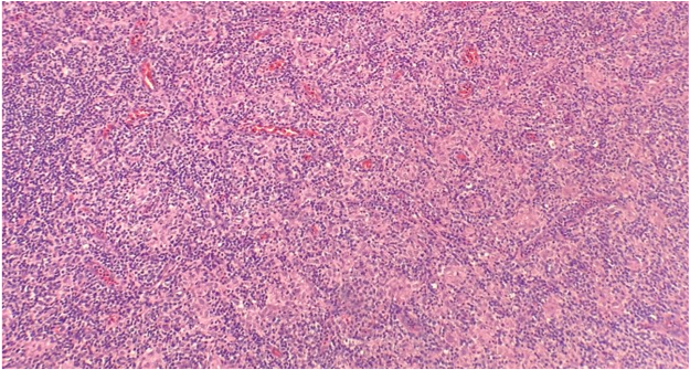 EmoryPathology's tweet photo. 🔬EMORY CASE OF THE WEEK #91:​

53M w/multistation lymphadenopathy

Answer the question below!

Contributor: Tanya Sajan Ponnatt, MBBS (@Tponnatt)

#hemepath #pathresidents #Emorypathres #EmoryCoTW #path2path #pathmatch23 #pathmatch2023 #PathTwitter https://t.co/fQ6fF5qs23