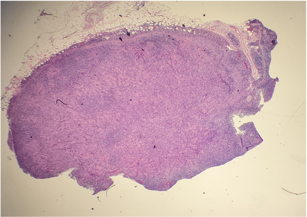 EmoryPathology's tweet photo. 🔬EMORY CASE OF THE WEEK #91:​

53M w/multistation lymphadenopathy

Answer the question below!

Contributor: Tanya Sajan Ponnatt, MBBS (@Tponnatt)

#hemepath #pathresidents #Emorypathres #EmoryCoTW #path2path #pathmatch23 #pathmatch2023 #PathTwitter https://t.co/fQ6fF5qs23