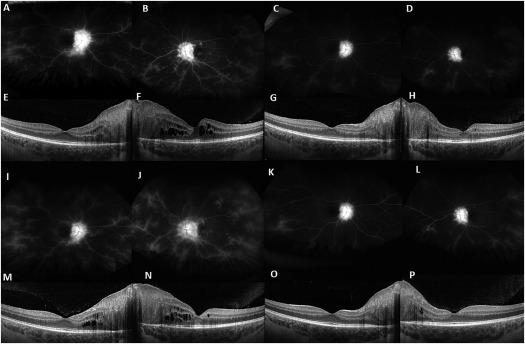 Ocular manifestations of ROSAH syndrome caused by variants in ALPK1: optic disc elevation, uveitis and retinal dystrophy. #uveitis #RetinalDystrophy <a href="/NatEyeInstitute/">NEI</a> <a href="/NHGRI/">NHGRI</a> <a href="/NIH/">NIH</a> ow.ly/IJ1z50LtJlk