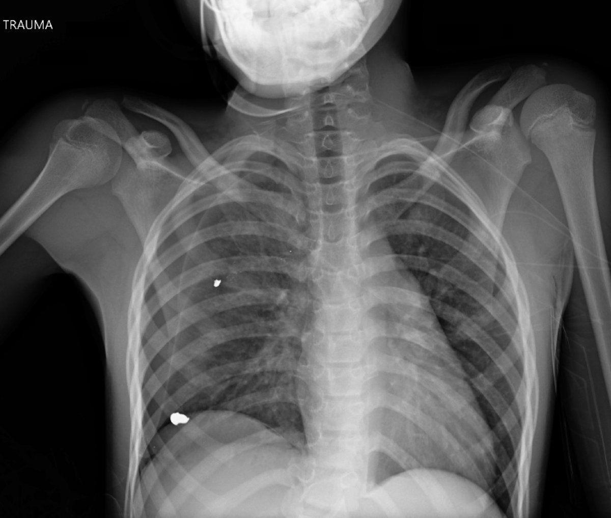 Here’s the Chest X-Ray of a young boy with a condition that is now the leading cause of death in children and adolescents in the U.S. What’s the diagnosis?