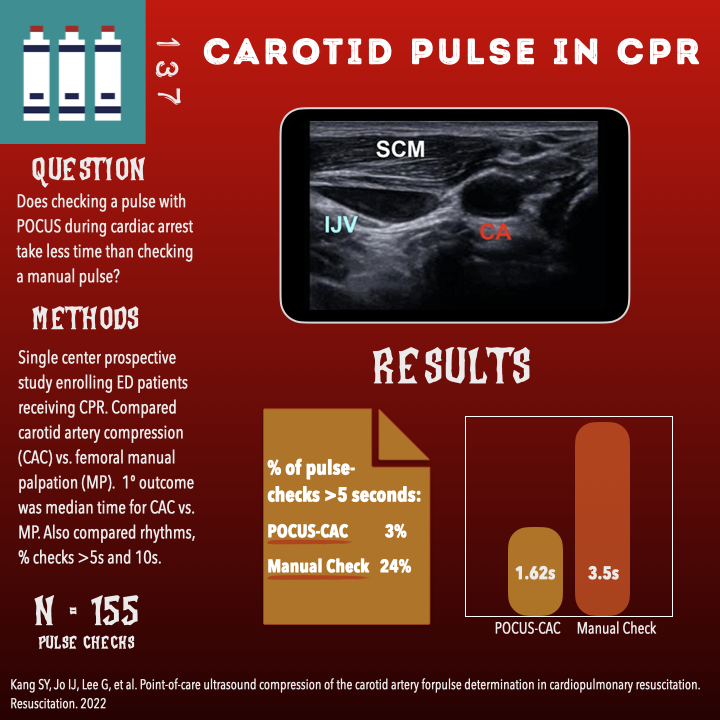 Ohio State Emergency Medicine Residency (@ohiostateemres) on Twitter photo #POCUS carotid compression for pulse checks in #CPR seems to save time compared to manual. Great discussion about how to integrate this data into practice by #USGEL team <a href="/PratsEM/">Michael I. Prats</a> <a href="/CreaghB/">Creagh Boulger ❤💚💜💙💛</a> @UltrasoundMD #POCUSpulsecheck ultrasoundgel.org/137 #POCUS carotid compression for pulse checks in #CPR seems to save time compared to manual. Great discussion about how to integrate this data into practice by #USGEL team <a href="/PratsEM/">Michael I. Prats</a> <a href="/CreaghB/">Creagh Boulger ❤💚💜💙💛</a> @UltrasoundMD #POCUSpulsecheck ultrasoundgel.org/137