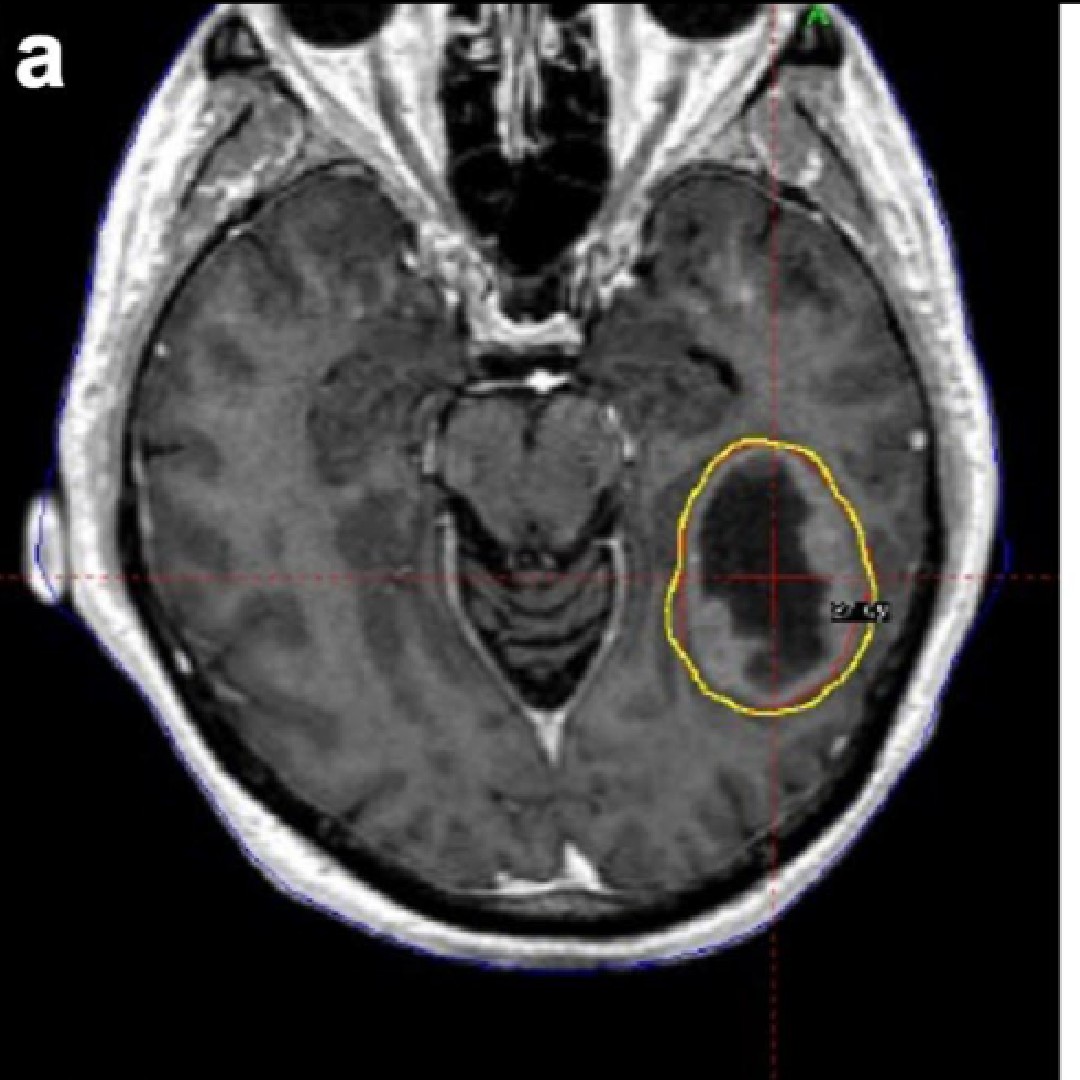 Journal of Neuro-Oncology tweet media